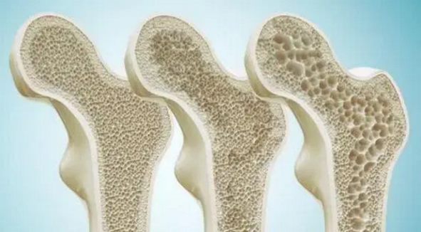 骨胶原蛋白营养增加骨密度效果