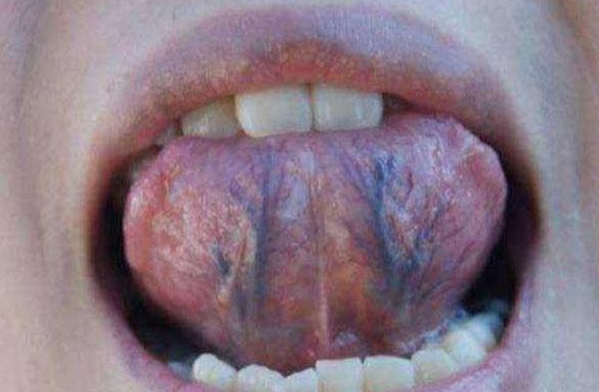 舌下青筋粗大真的代表体内有癌症吗