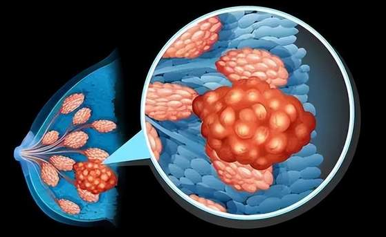 免疫疗法与治疗乳腺癌