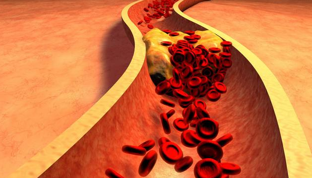 老年人胆固醇升高根本原因还是需要的少
