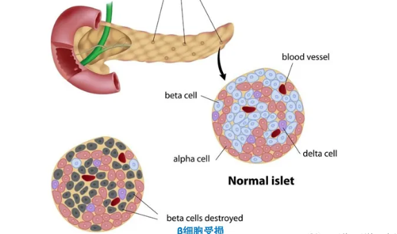 制造人类胰岛器官是否可行!