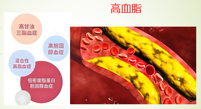 高血脂.png