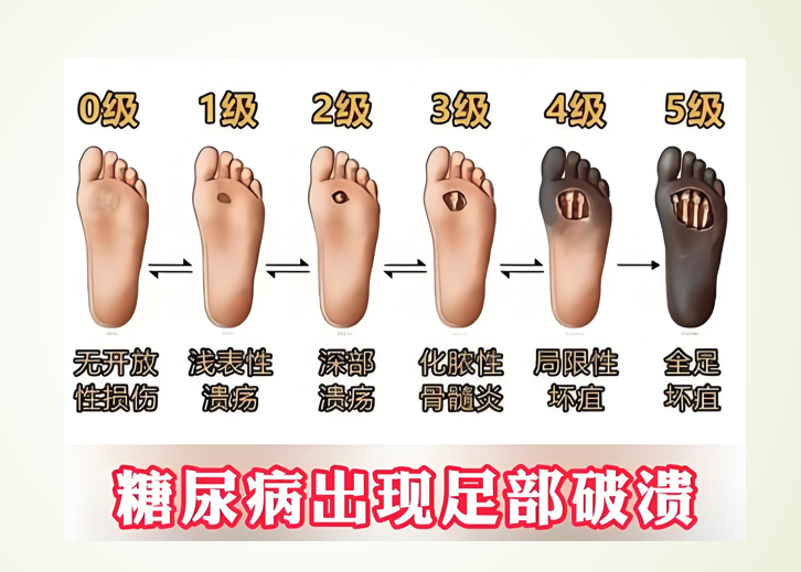 糖尿病足的发病机制.png