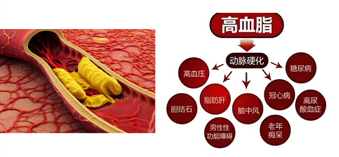 高血脂的危害.png 高血脂的危害.png